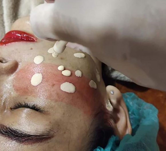 การฝังสีรองพื้นกึ่งถาวร 2